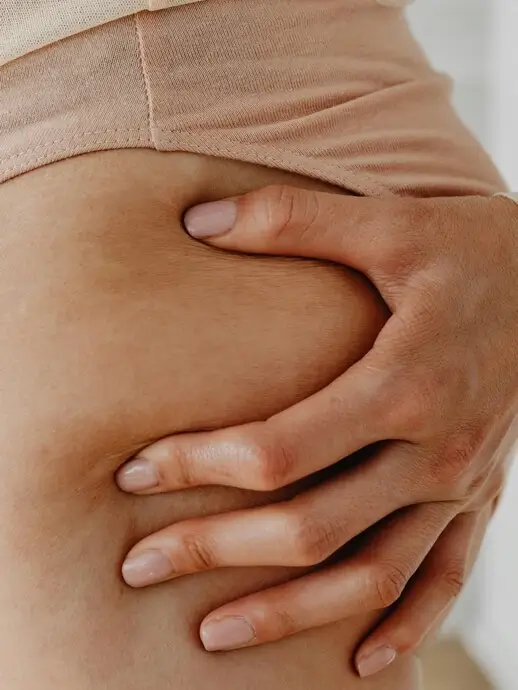 Cellulite